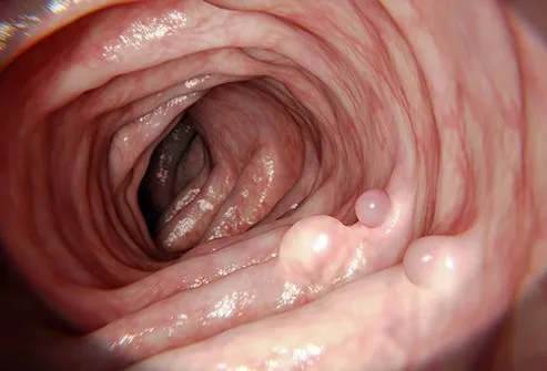 colon polyps sumptomite kaalulangus vblock kaalulanguse ulevaated