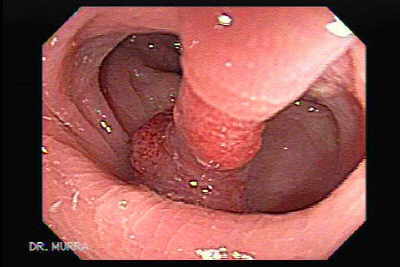 colon polyps sumptomite kaalulangus 8 naela kuus kaalulangus