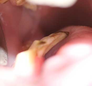 hammaste abstsess kaalulangus poletage rasva tnb 28