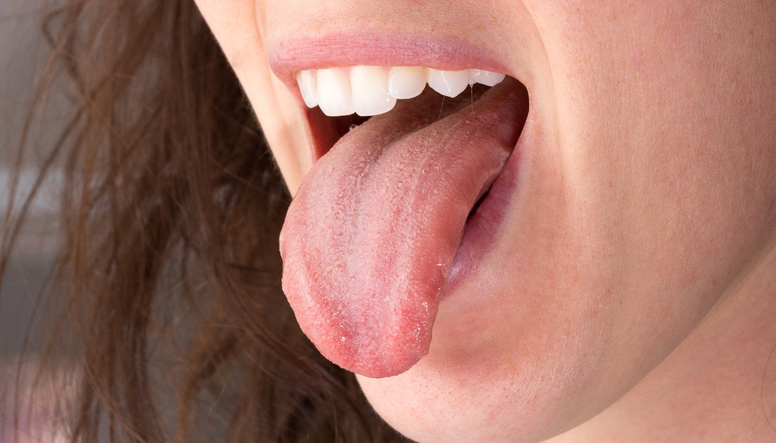 valged laigud keele ja kaalulangus rasva poletamine kuldne piimakokook